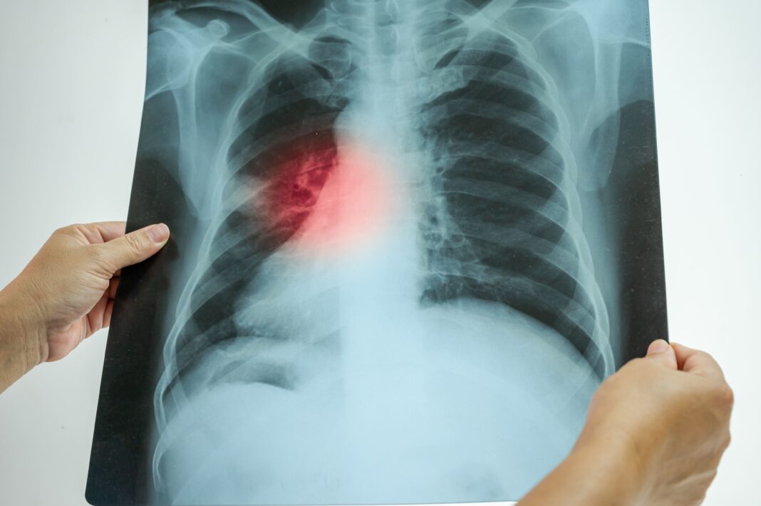 Doctor,Hand,Point,Patient,Lung,X-ray,Film,Before,Treatment,For gruźlica