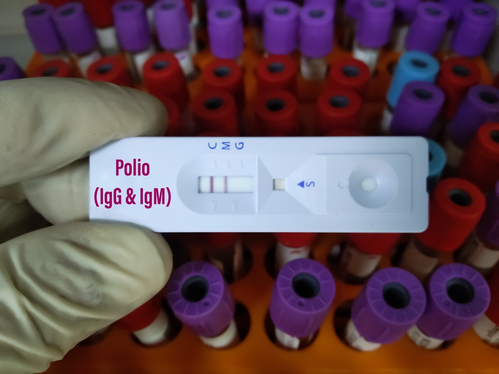 Wirus Polio wykryty w Londynie. Czy istnieje zagrożenie dla zdrowia?